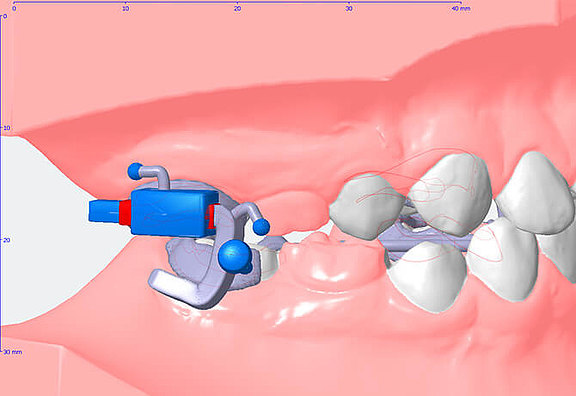 3d Apparaturdesign für Mini-Implantate