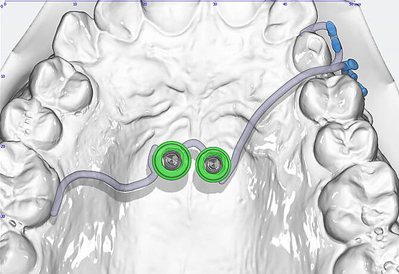 3D Modell des Mini Implantates