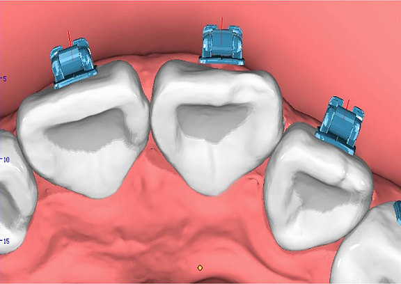 Durch digitale Positionierung der Brackets lassen sich finale Positionierungen perfekt einschätzen