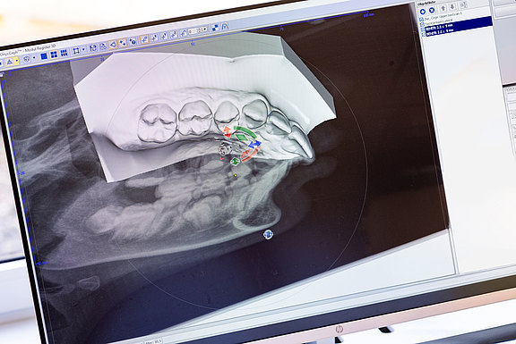 Für die Planung uns Insertion von Mini-Implantaten setzen wir 3D Technologie ein