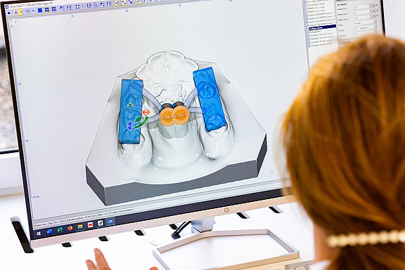 3D Design einer Bohrschablone in modernster Software