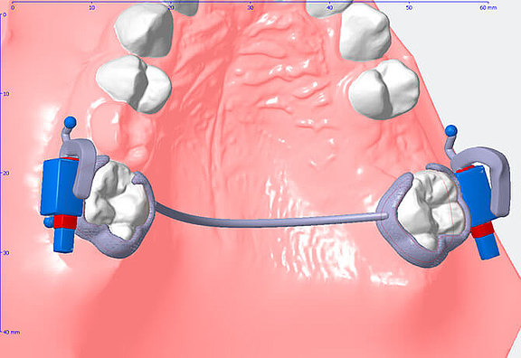 3D Apparaturdesign für Mini-Implantate