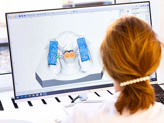 Zahntechnikerin nutzt modernste 3D Software. Bildschirm zeigt die Planung einer Bohrschablone für skelettale Verankerungen