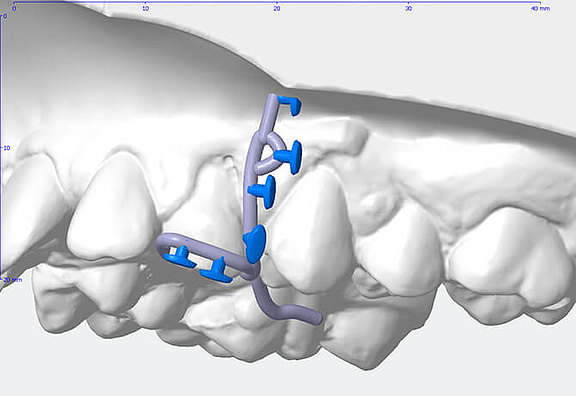 3D Design eines Mini-Implantates für die skelettale Verankerung