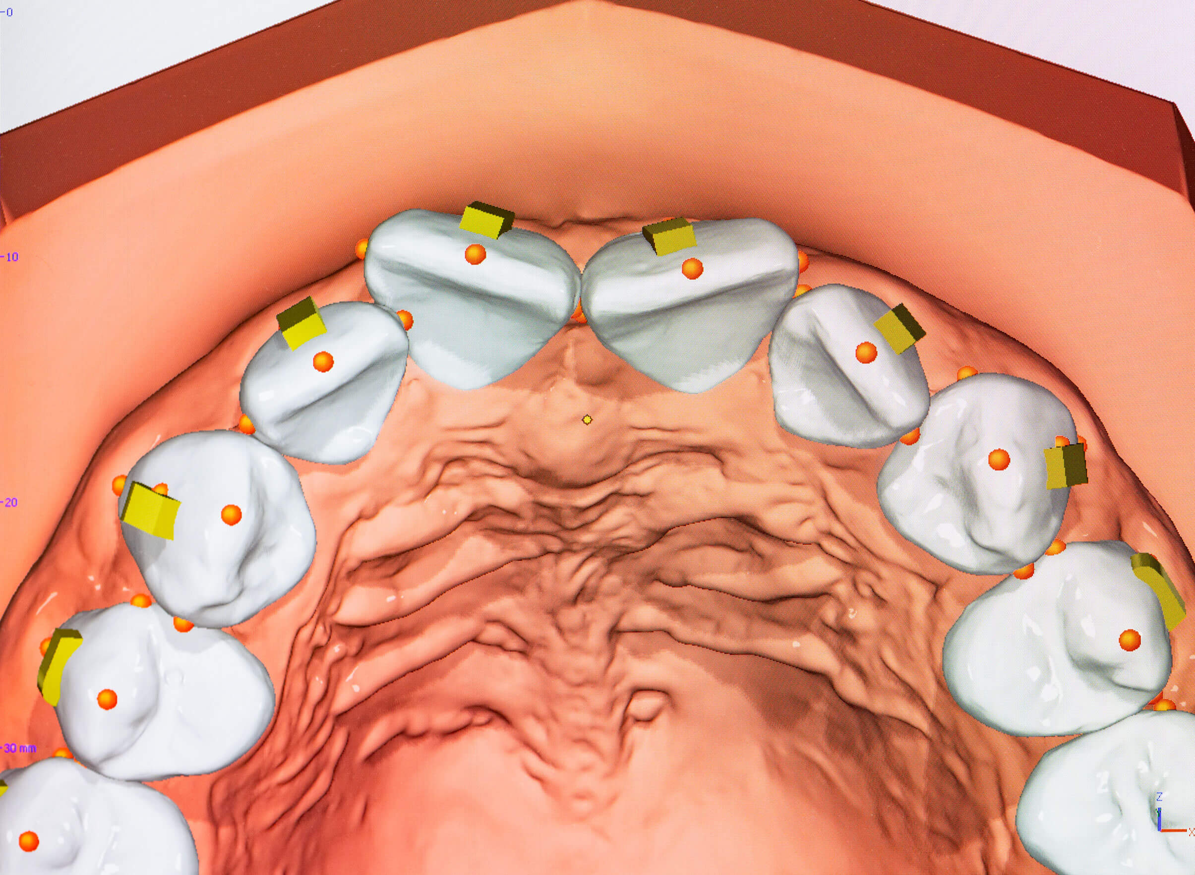 3D Modell Ausgangsbefund für Digitale Diagnostik und virtuelle Bißkorrektur 