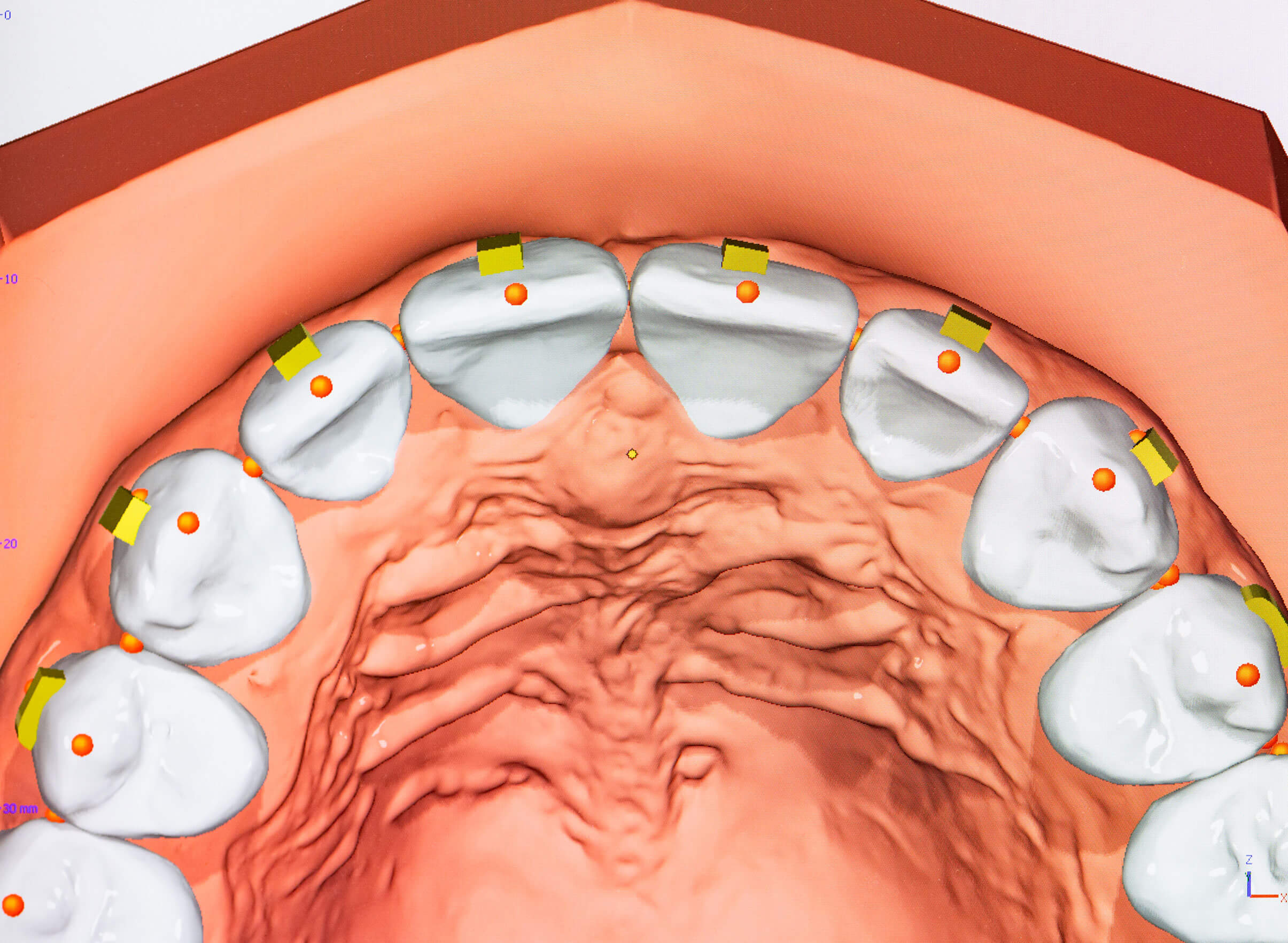 3D Modell korrigierte Zähne für Digitale Diagnostik und virtuelle Bißkorrektur 